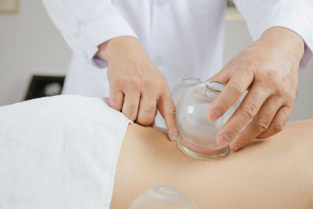 Therapeut führt Schröpfbehandlung mit Schröpfgläsern durch